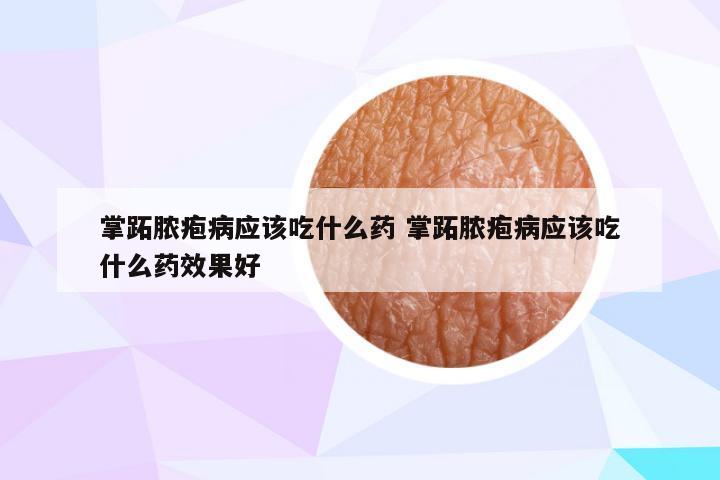 掌跖脓疱病应该吃什么药 掌跖脓疱病应该吃什么药效果好