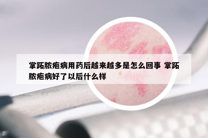 掌跖脓疱病用药后越来越多是怎么回事 掌跖脓疱病好了以后什么样