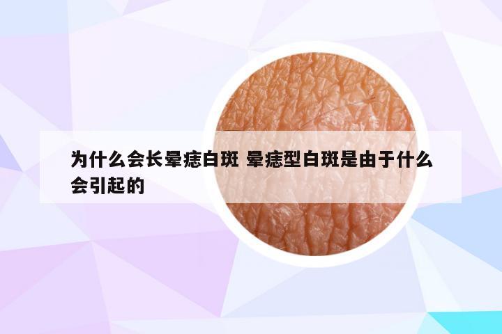 为什么会长晕痣白斑 晕痣型白斑是由于什么会引起的