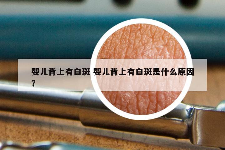婴儿背上有白斑 婴儿背上有白斑是什么原因?