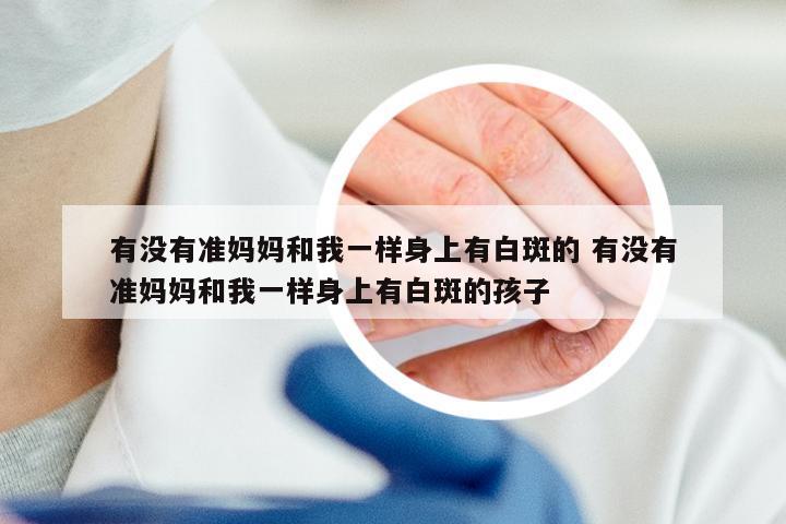有没有准妈妈和我一样身上有白斑的 有没有准妈妈和我一样身上有白斑的孩子