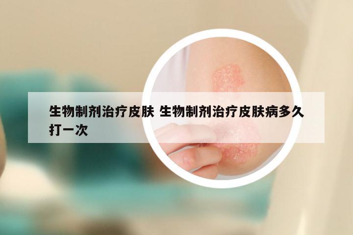 生物制剂治疗皮肤 生物制剂治疗皮肤病多久打一次