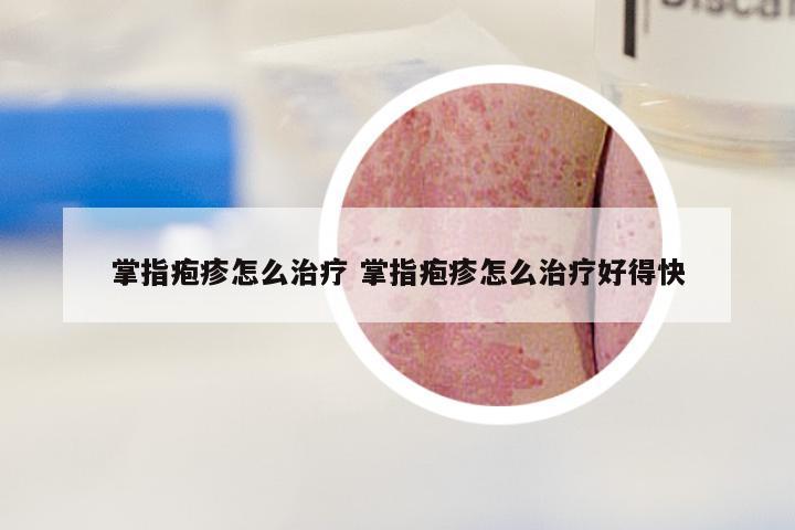 掌指疱疹怎么治疗 掌指疱疹怎么治疗好得快