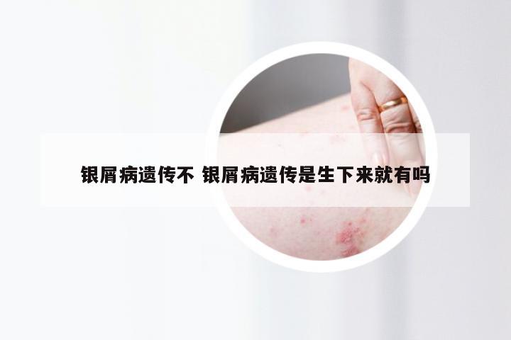 银屑病遗传不 银屑病遗传是生下来就有吗