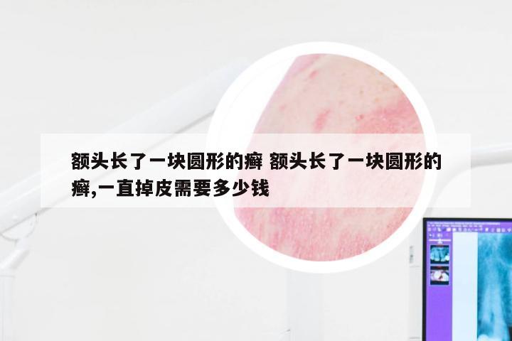 额头长了一块圆形的癣 额头长了一块圆形的癣,一直掉皮需要多少钱