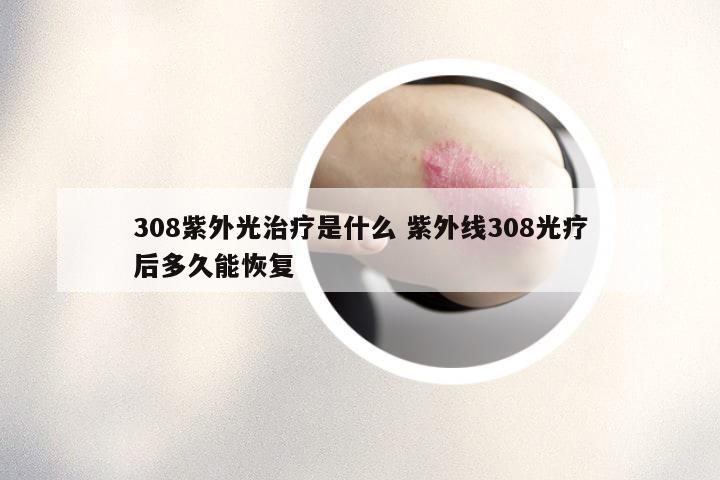 308紫外光治疗是什么 紫外线308光疗后多久能恢复