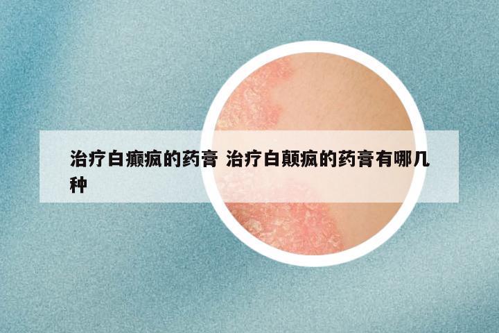 治疗白癫疯的药膏 治疗白颠疯的药膏有哪几种