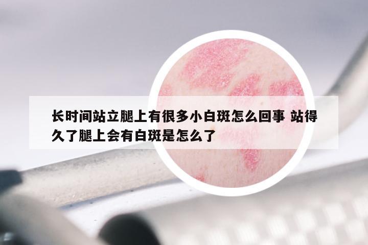 长时间站立腿上有很多小白斑怎么回事 站得久了腿上会有白斑是怎么了