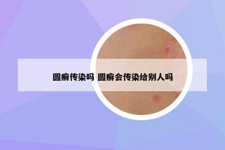 圆癣传染吗 圆癣会传染给别人吗