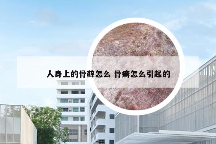 人身上的骨藓怎么 骨癣怎么引起的