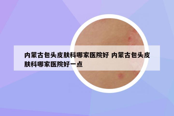 内蒙古包头皮肤科哪家医院好 内蒙古包头皮肤科哪家医院好一点