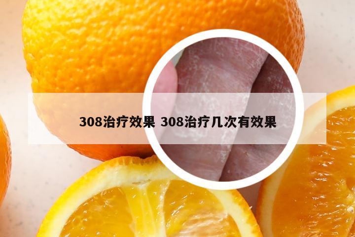 308治疗效果 308治疗几次有效果