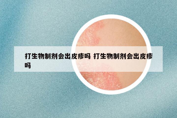 打生物制剂会出皮疹吗 打生物制剂会出皮疹吗
