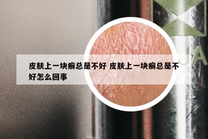 皮肤上一块癣总是不好 皮肤上一块癣总是不好怎么回事