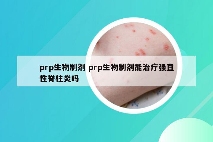 prp生物制剂 prp生物制剂能治疗强直性脊柱炎吗