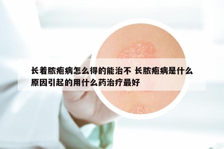 长着脓疱病怎么得的能治不 长脓疱病是什么原因引起的用什么药治疗最好