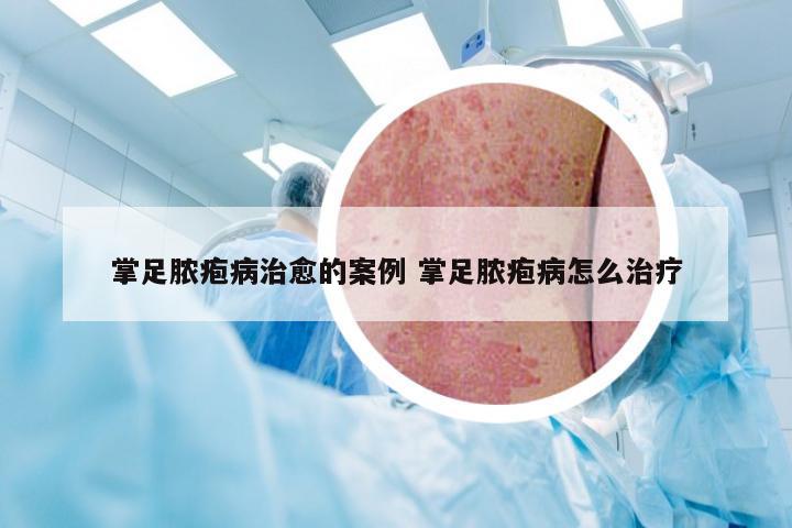 掌足脓疱病治愈的案例 掌足脓疱病怎么治疗