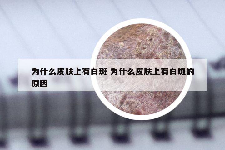 为什么皮肤上有白斑 为什么皮肤上有白斑的原因