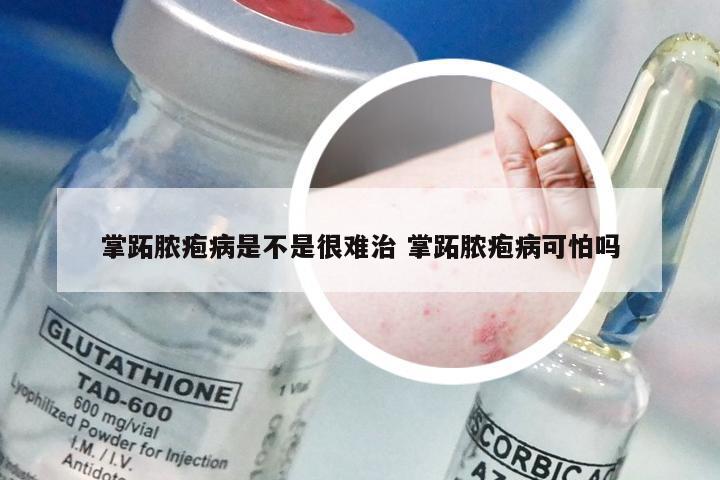 掌跖脓疱病是不是很难治 掌跖脓疱病可怕吗