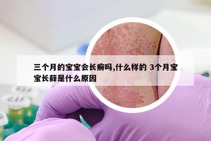 三个月的宝宝会长癣吗,什么样的 3个月宝宝长藓是什么原因