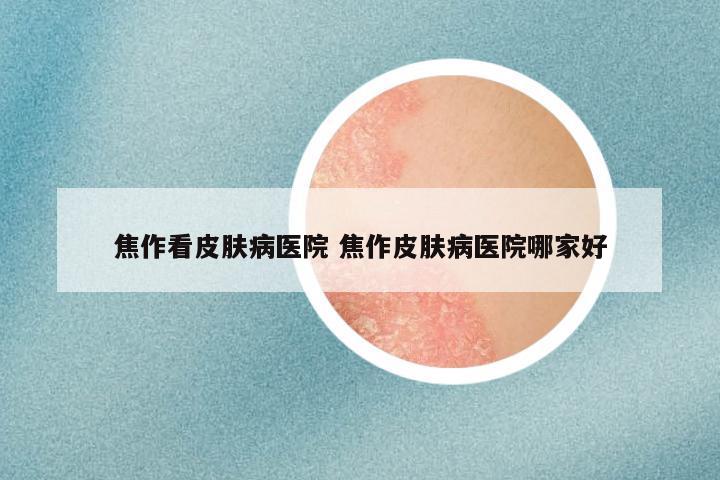焦作看皮肤病医院 焦作皮肤病医院哪家好