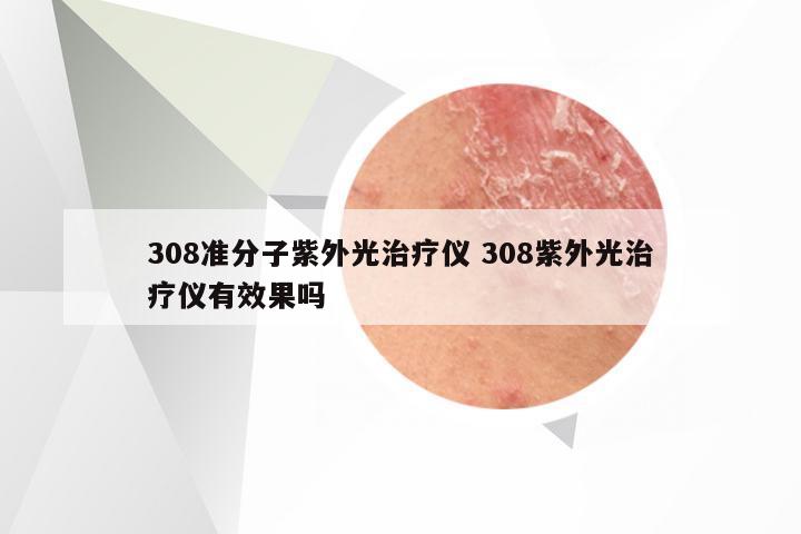 308准分子紫外光治疗仪 308紫外光治疗仪有效果吗