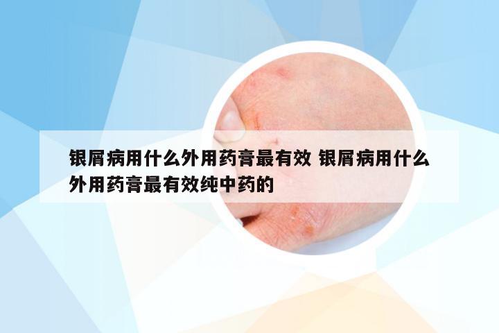银屑病用什么外用药膏最有效 银屑病用什么外用药膏最有效纯中药的