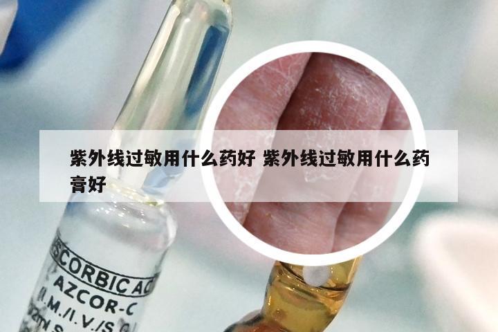 紫外线过敏用什么药好 紫外线过敏用什么药膏好