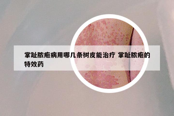 掌趾脓疱病用哪几条树皮能治疗 掌趾脓疱的特效药