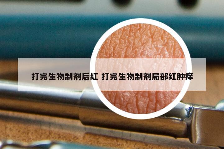 打完生物制剂后红 打完生物制剂局部红肿痒