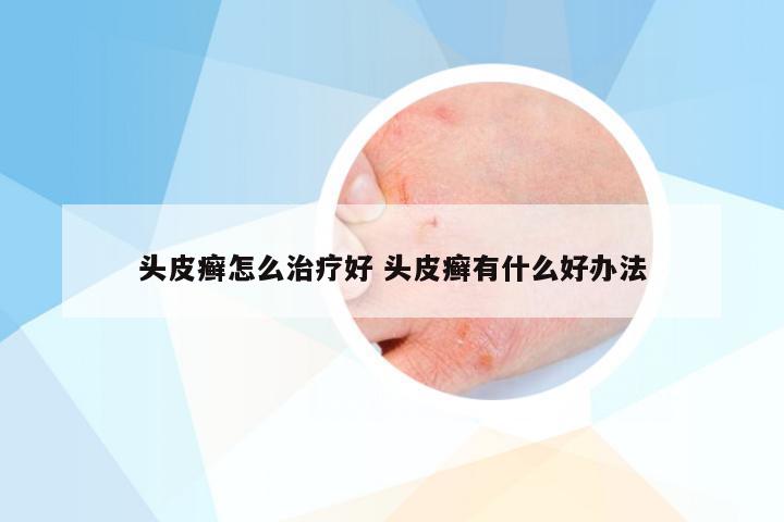 头皮癣怎么治疗好 头皮癣有什么好办法