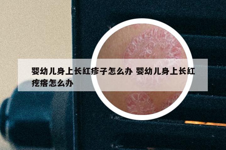 婴幼儿身上长红疹子怎么办 婴幼儿身上长红疙瘩怎么办