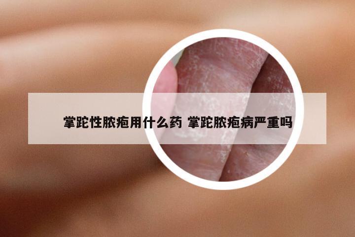 掌跎性脓疱用什么药 掌跎脓疱病严重吗