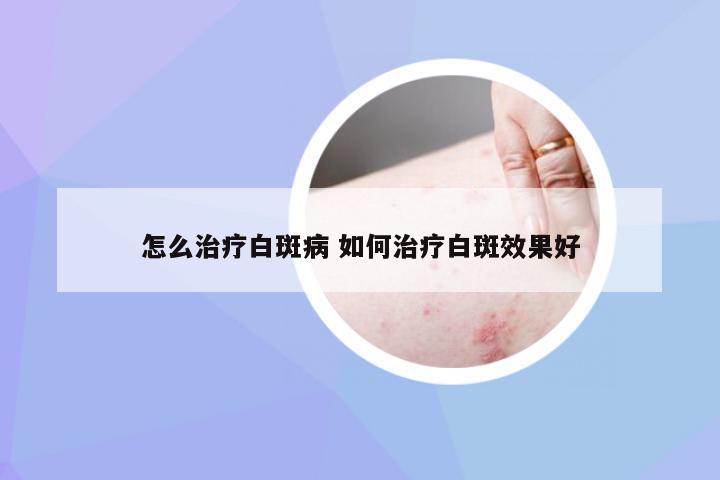 怎么治疗白斑病 如何治疗白斑效果好