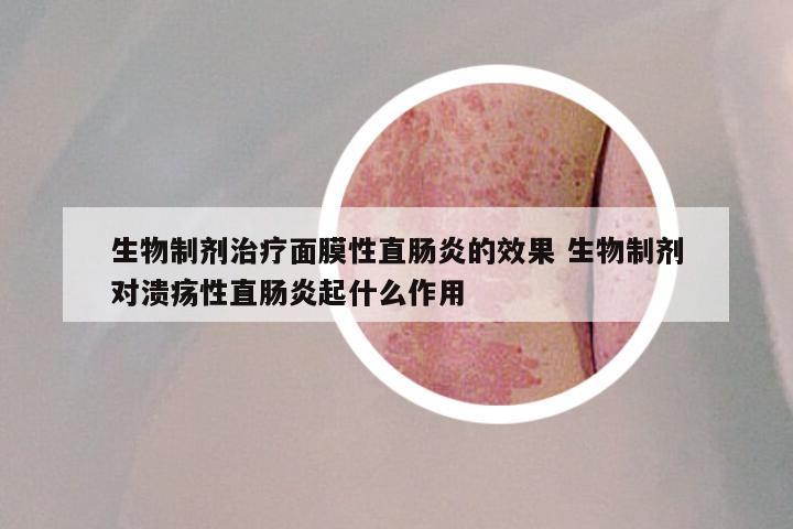 生物制剂治疗面膜性直肠炎的效果 生物制剂对溃疡性直肠炎起什么作用