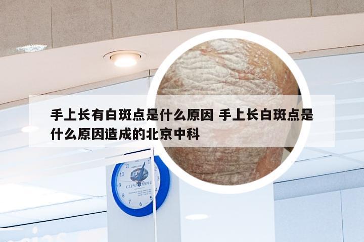 手上长有白斑点是什么原因 手上长白斑点是什么原因造成的北京中科
