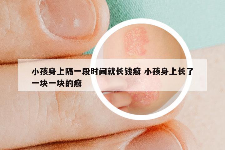 小孩身上隔一段时间就长钱癣 小孩身上长了一块一块的癣