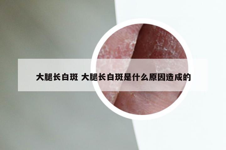 大腿长白斑 大腿长白斑是什么原因造成的