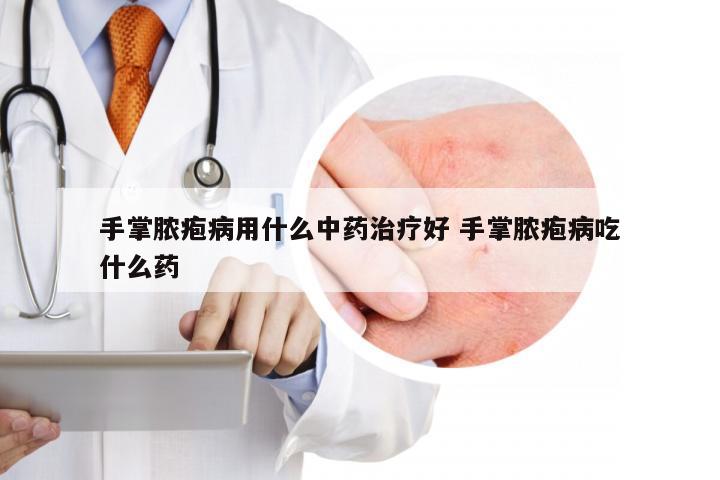 手掌脓疱病用什么中药治疗好 手掌脓疱病吃什么药