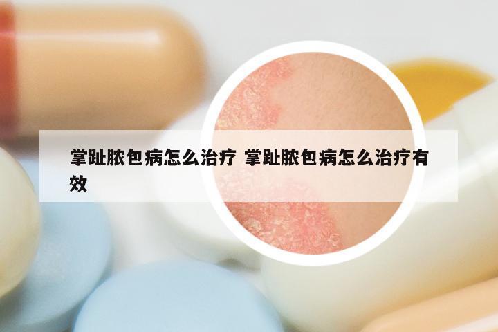 掌趾脓包病怎么治疗 掌趾脓包病怎么治疗有效