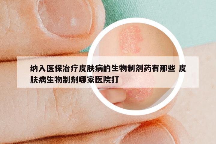 纳入医保冶疗皮肤病的生物制剂药有那些 皮肤病生物制剂哪家医院打