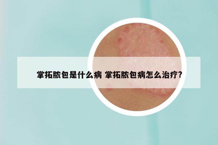 掌拓脓包是什么病 掌拓脓包病怎么治疗?