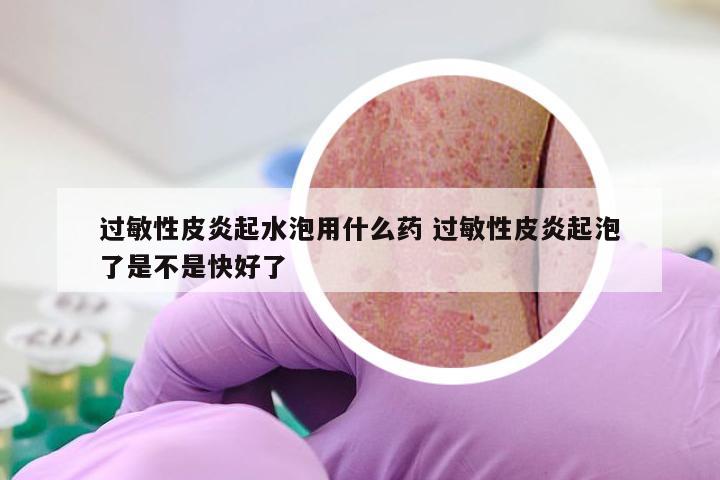 过敏性皮炎起水泡用什么药 过敏性皮炎起泡了是不是快好了