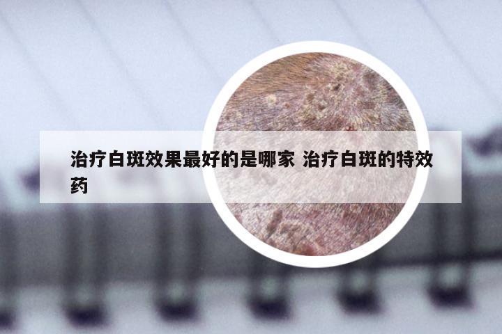 治疗白斑效果最好的是哪家 治疗白斑的特效药