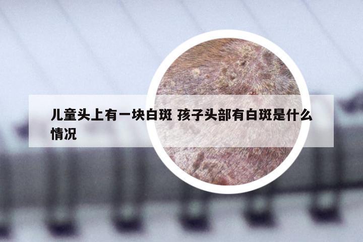 儿童头上有一块白斑 孩子头部有白斑是什么情况