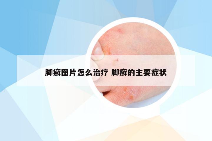 脚癣图片怎么治疗 脚癣的主要症状