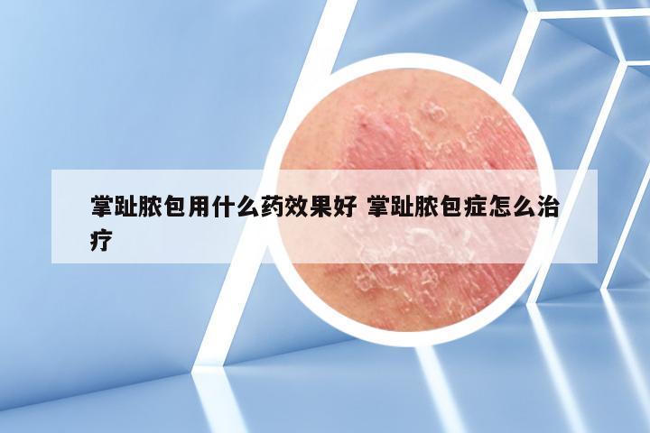 掌趾脓包用什么药效果好 掌趾脓包症怎么治疗