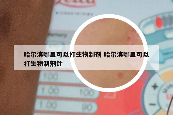 哈尔滨哪里可以打生物制剂 哈尔滨哪里可以打生物制剂针