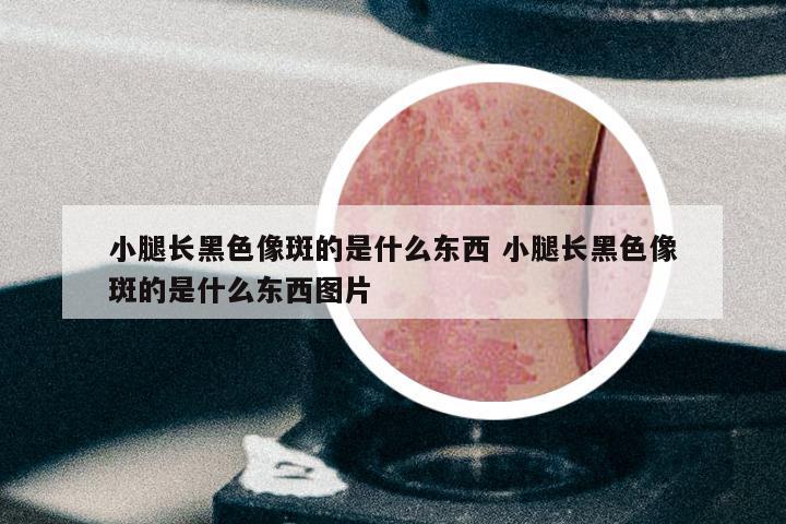 小腿长黑色像斑的是什么东西 小腿长黑色像斑的是什么东西图片