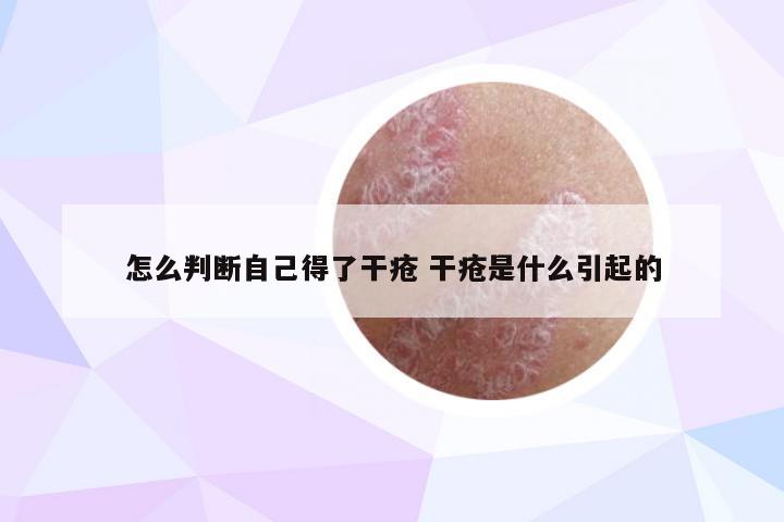 怎么判断自己得了干疮 干疮是什么引起的